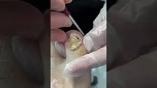 🦶😭 OMG Painful Nails Inside skin #nailout #nailscut #nailscare #naildoctor #nails #shorts