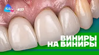 Виниры на виниры | Дентал Кейсы от BG #37