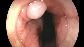 ESD of an anal condyloma
