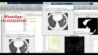 Lung Cancer Detection Using Matlab Project Source Code