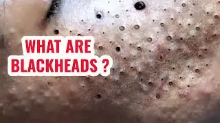 Everything you need to know about blackheads