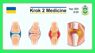[ Krok 2 Medicine ] Year: 2021 - 031 (Ministry of Public Health of Ukraine)