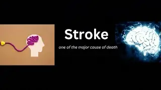 STROKE | Stroke treatment | Ischemic stroke | Haemorrhage stroke | Stroke recovery