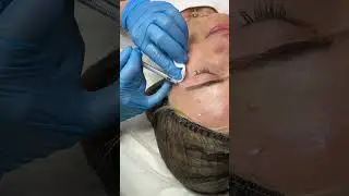 Обучение Ботулинотерапия. 1-й пациент.