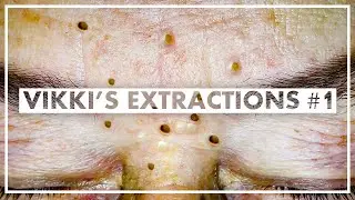Could it be my last video? Is YouTube shutting down pimple popping?