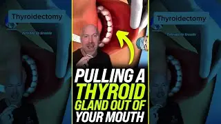 Pulling a Thyroid Out of Your Mouth 😱 