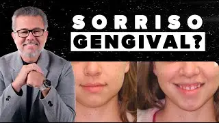 Correção de Sorriso Gengival com Mini-Implantes 😁