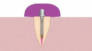 Flexi-Overdenture Animated Technique: Indirect / Coping Procedure