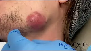 Drainage of an infected cyst on the jaw line