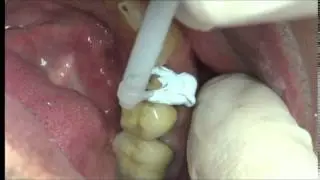Tissue Management Impression System
