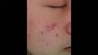 Photodynamic therapy to treat acne painlessly.