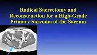 Radical Sacrectomy and Reconstruction for a High Grade Primary Sarcoma of the Sacrum