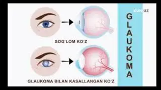 #Ko’z_kasalliklari #tabiiy_yol_bilan_davolash #kuzni_davolash #glaukoma