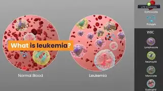 #Whatisleukemia | Lifechangingtv