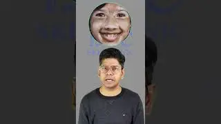 How to cure Different types of Vitiligo | Dr, Rohit Goel | Vitiligo age, Vitiligo Size treatments.