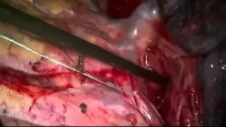 Ligation of the Thoracic Duct by a Posterior VATS Approach