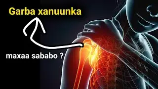 Garbaha xanuun Maka dareentaa iyo feeraha ? Calaamadahaan hadii ee kuu Soo raacaan waxaa sababay...