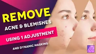 Remove and Clean ACNE, BLEMISHES and SPOTS like a PRO in Affinity Photo