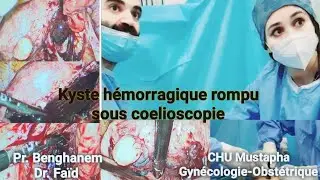 kyste hémorragique rompu sous coelioscopie
