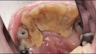 MASSIVE Calculus Buildup | Severe Gum Disease Case