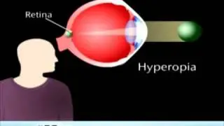 Farsightedness