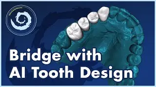BSP V4.13: Design a Bridge With Automatic Tooth Design. Design and Export Free.