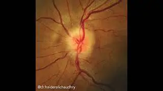 Papilloedema