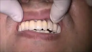 Interim PEEK implant supported fixed prosthesis
