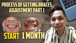 PROCESS OF GETTING BRACES|ADJUSTMENT|PART 1