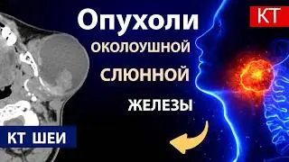 Лучевая диагностика опухолей околоушной слюнной железы