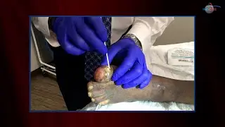 WCW: Clinical Evaluation of a Toe Fracture
