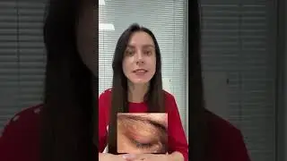 Миллиумы на коже