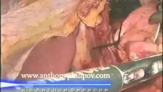 Лапароскопска операция при ахалазия - част 2