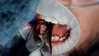 46,47 norris implant - intraoral syncrystallisation by using 1.2 mm titanium  wire
