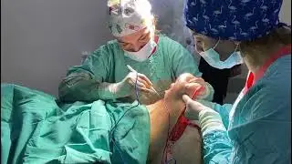 Abdominoplastika əməliyyatı