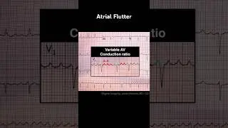 Atrial Flutter ECG: Variable AV conduction ratio