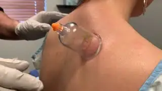 Cupping Therapy for Neck and Back Pain 