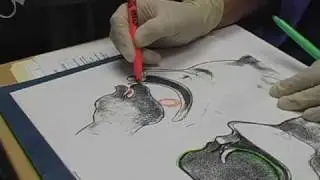 Tongue Thrust Therapy