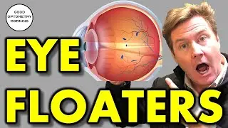 FLASHES & FLOATERS IN MY VISION: What does it mean & what should I do about it? Vitreous detachment