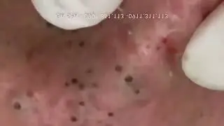 НОВОЕ ВИДЕО 2021  Акне  Прыщи давить залипательные