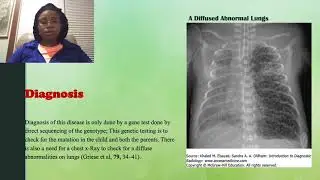 Surfactant protein B and C Deficiency