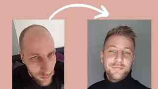 Hair Transplant in Turkey! Where did i do my two Hairtransplantation