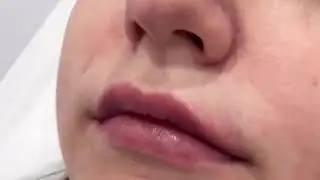 Контурная пластика губ