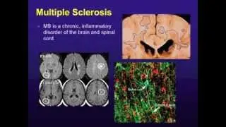 Multiple Sclerosis