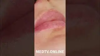 Коррекция губ