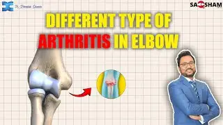 What is Elbow Arthritis@saqshamortho1346