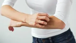 For Our Referring Providers: Urticaria