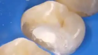 Dr. Mina's case YT #1 : Complete Pulpotomy for upper 1st premolar