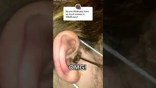 Black head removal on face - Blackheads on back treatment