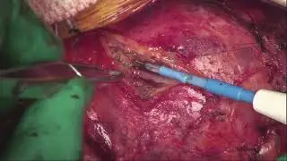 Unroofing of LAD Myocardial Bridge Combined With Right Ventricular Septal Myectomy